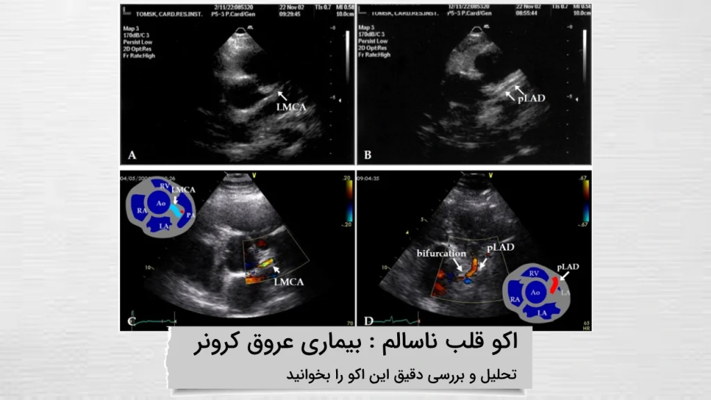 اکو قلب ناسالم با مشکل بیماری عروق کرونر تصویر اکو قلب ناسالم با مشکل بیماری عروق کرونر