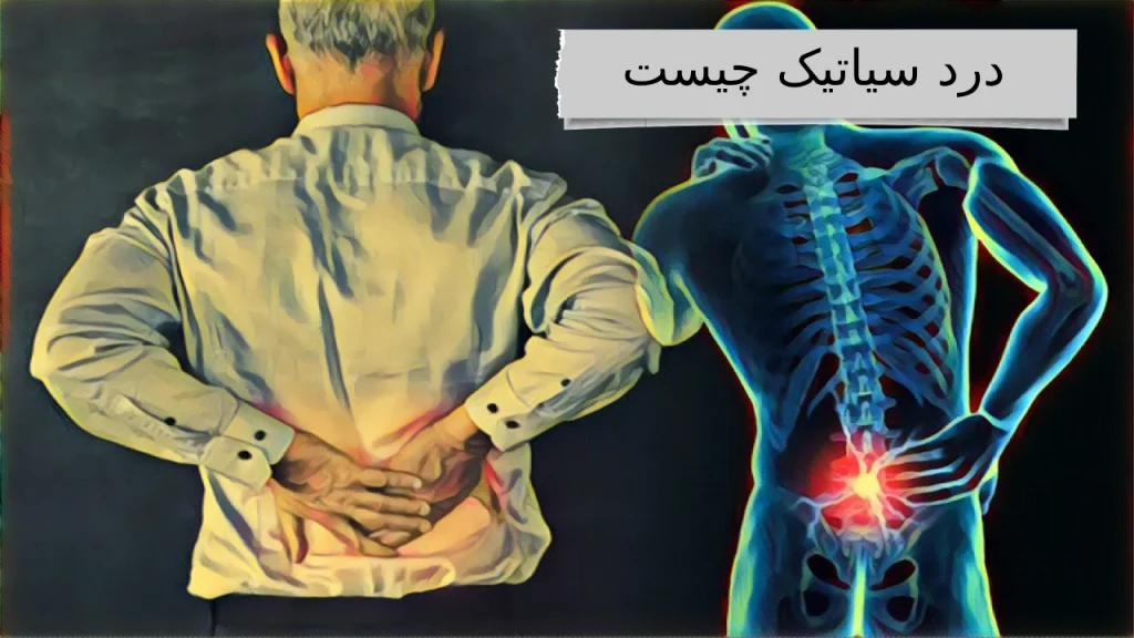 درد سیاتیک چیست درد سیاتیک ، دردی آزاردهنده از کمر تا نوک پا
