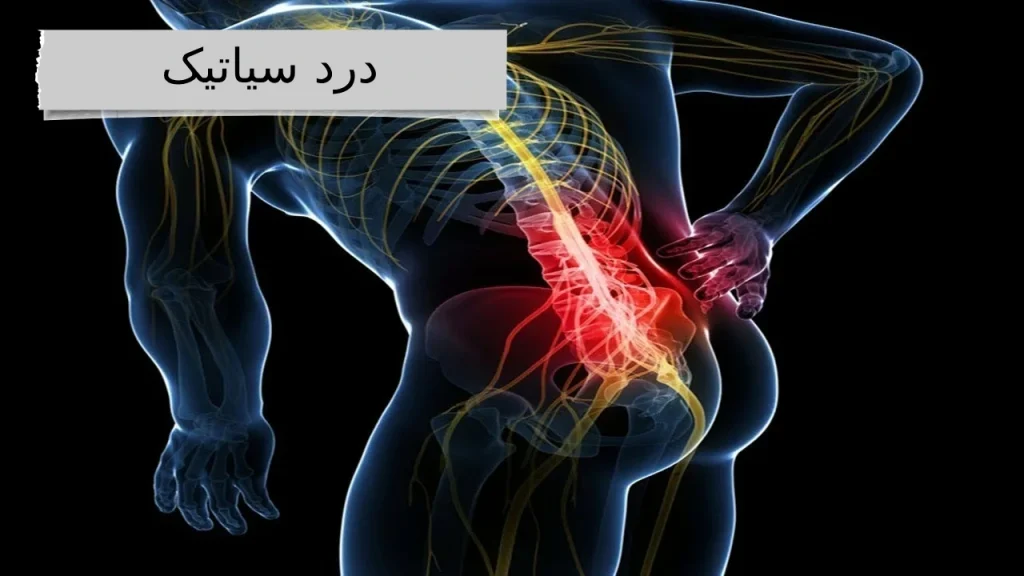 درد سیاتیک ، دردی آزاردهنده از کمر تا نوک پا