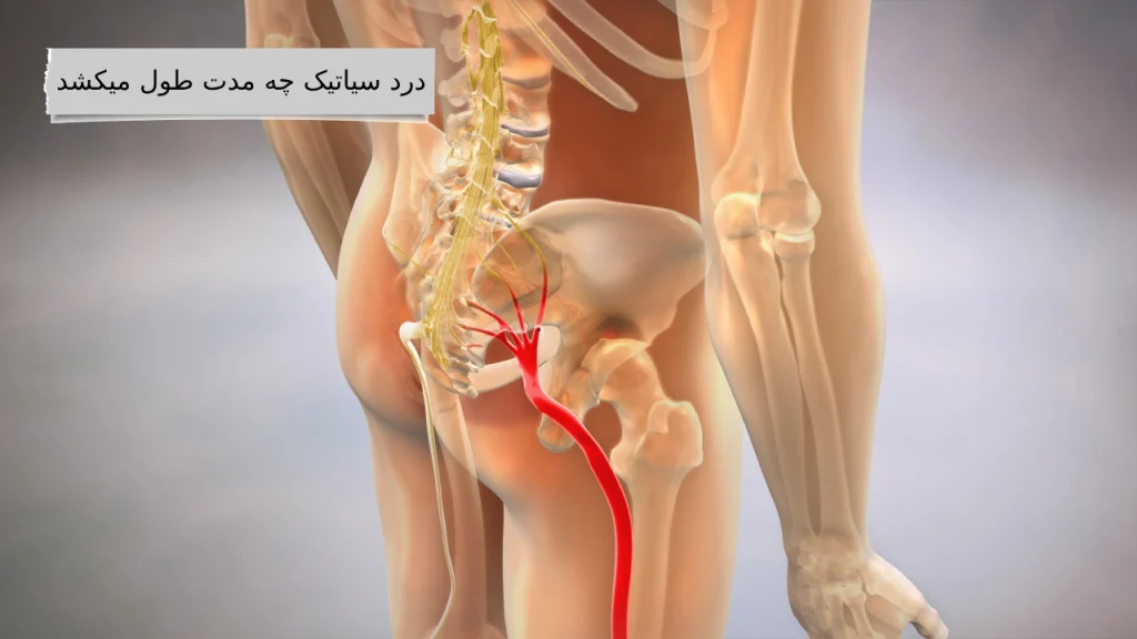 درد سیاتیک چه مدت طول میکشد درد سیاتیک ، دردی آزاردهنده از کمر تا نوک پا