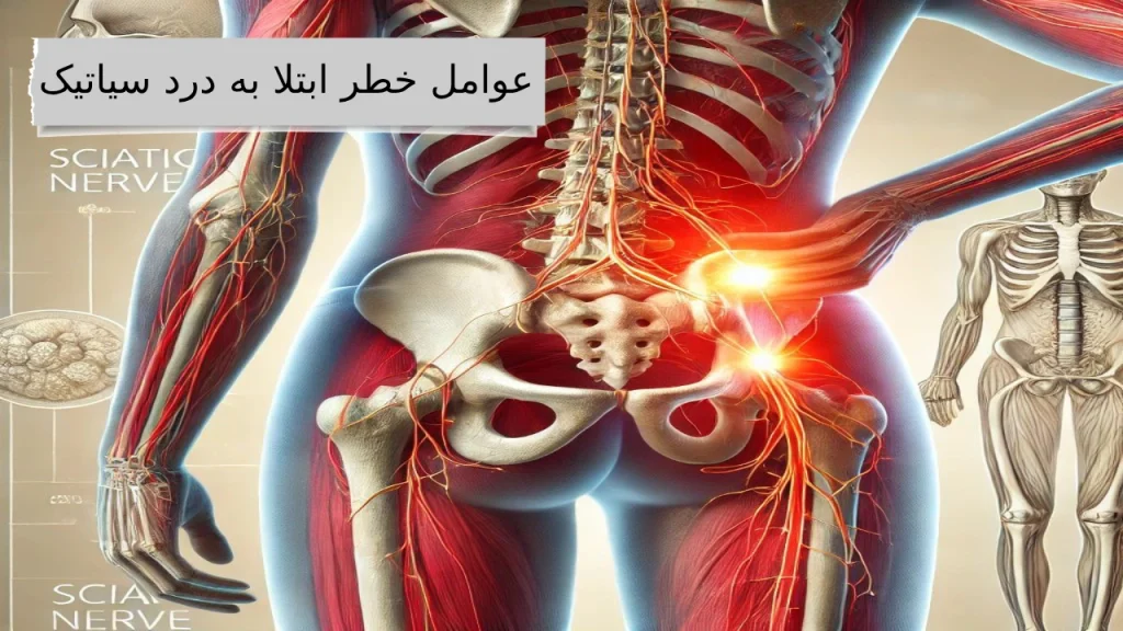 عوامل خطر ابتلا به درد سیاتیک درد سیاتیک ، دردی آزاردهنده از کمر تا نوک پا