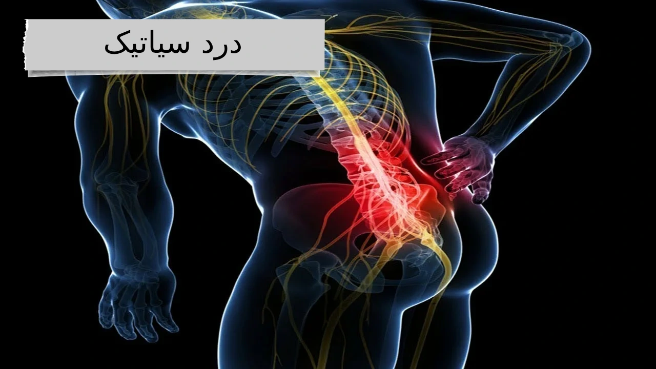 درد سیاتیک ، دردی آزاردهنده از کمر تا نوک پا