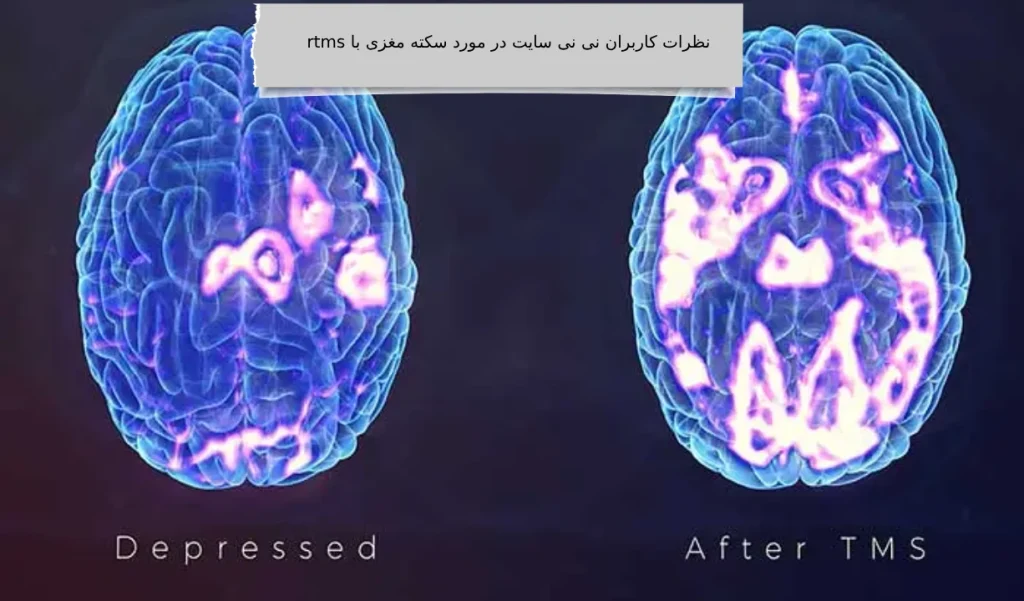 نظرات کاربران نی نی سایت در مورد درمان سکته مغری با rtms نظرات کاربران نی نی سایت در مورد درمان سکته مغری با rtms در ویستان