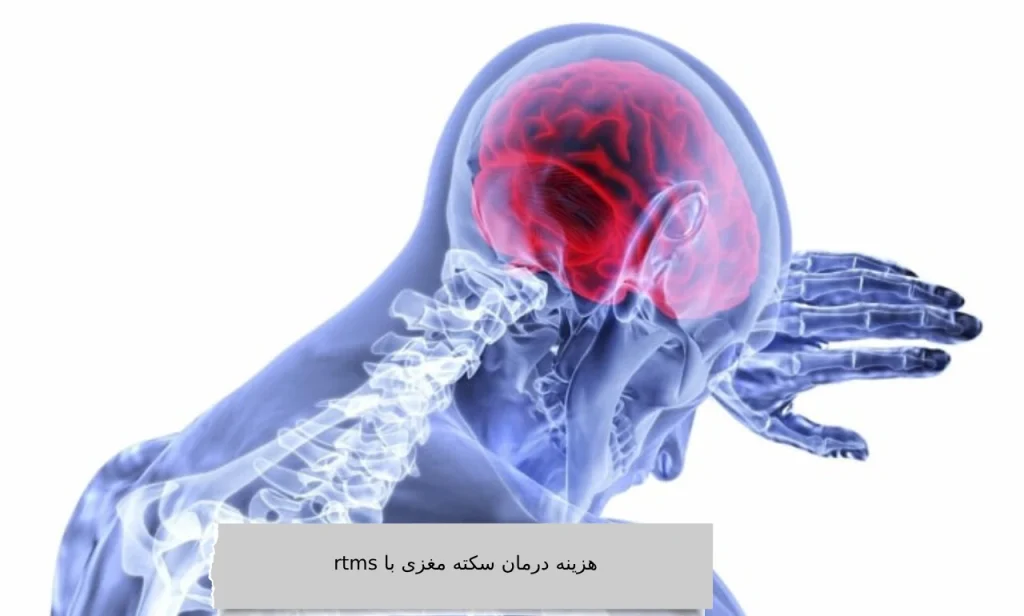 هزینه درمان سکته مغری با rtms در ویستان هزینه درمان سکته مغری با rtms در ویستان