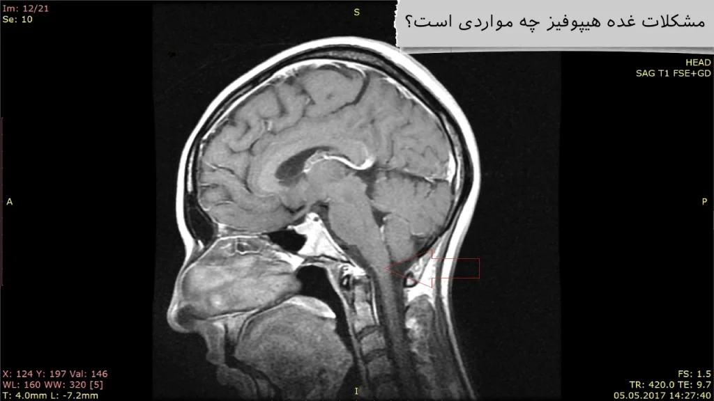 مشکلات غده هیپوفیز بهترین جراح هیپوفیز ایران