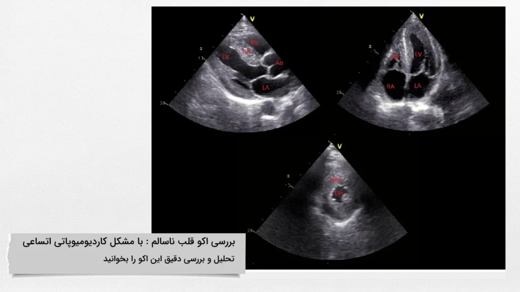تحلیل و بررسی عکس اکو قلب ناسالم با مشکل کاردیو میوپاتی اتساعی اکو قلب ناسالم با مشکل کاردیو میوپاتی اتساعی