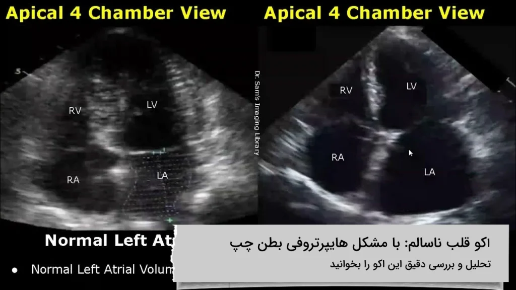 بررسی اکو قلب ناسالم با مشکل هایپرتروفی بطن چپ اکو قلب ناسالم با مشکل هایپرتروفی بطن چپ