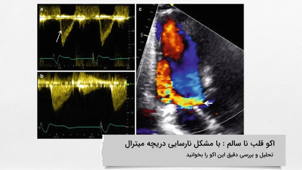 تحلیل و بررسی عکس اکو قلب ناسالم با مشکل نارسایی دریچه میترال اکو قلب ناسالم با مشکل نارسایی دریچه میترال