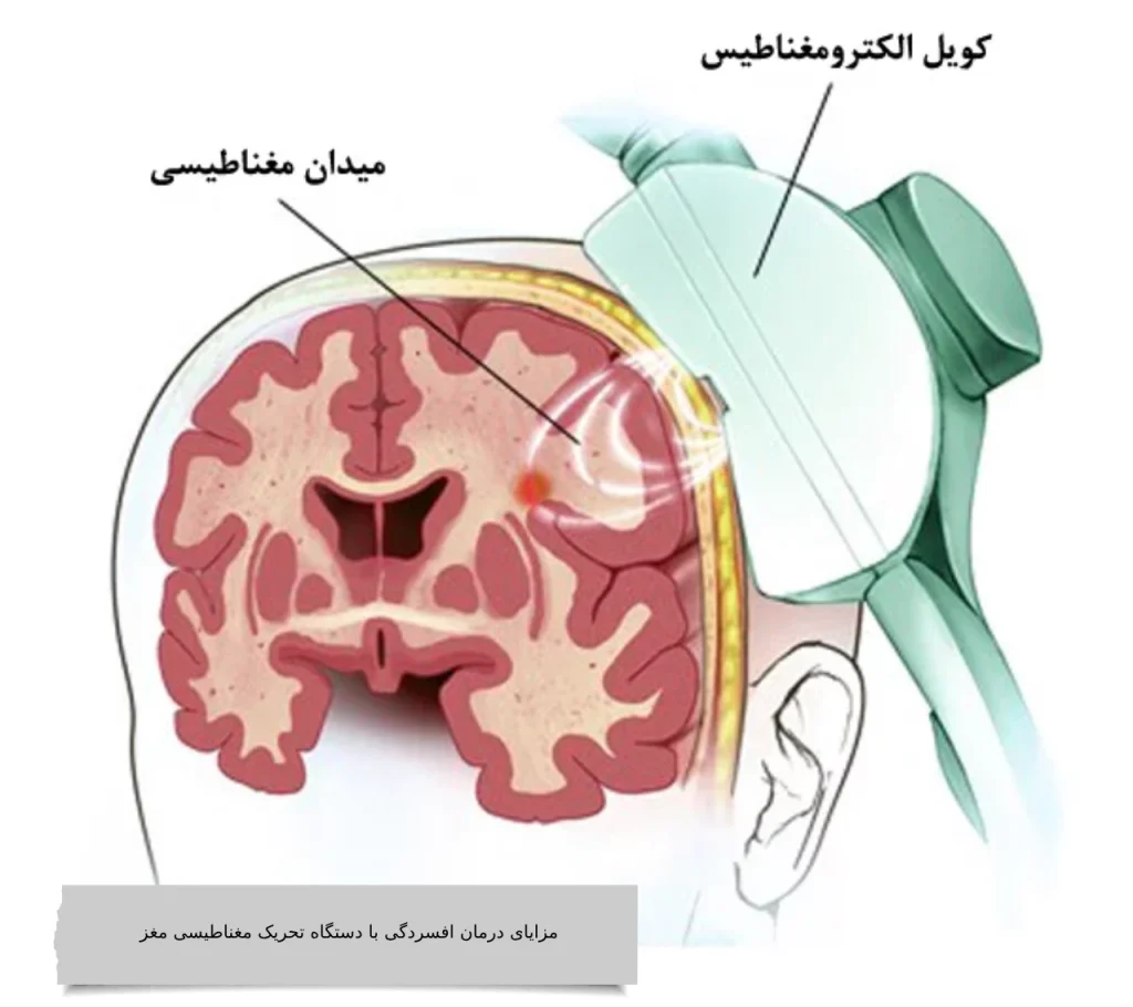 مزایای درمان افسردگی با دستگاه تحریک مغناطیسی مغز