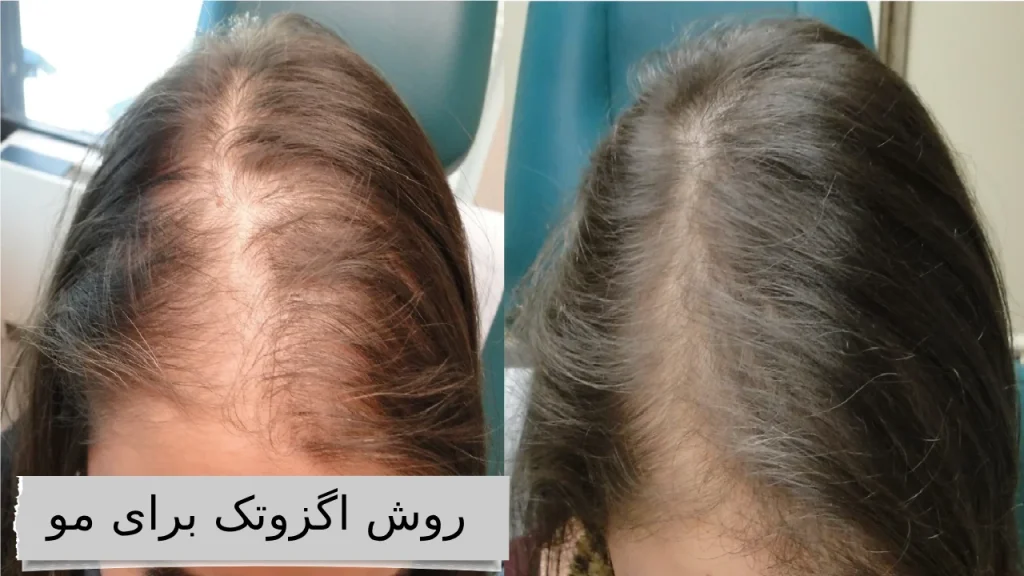 گزوم مو؛ جادوی تناسب و ظرافت، برای موهایی که داستان زیبایی شما را روایت می‌کنند