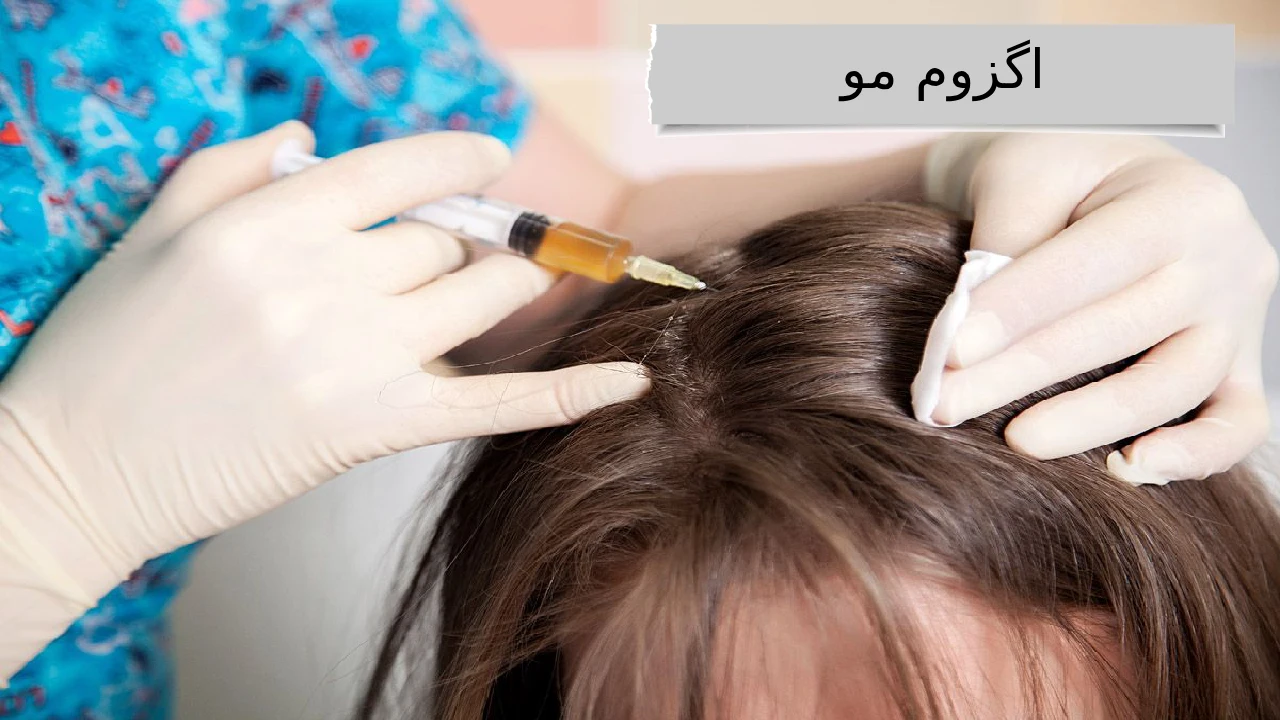 اگزوم مو؛ جادوی تناسب و ظرافت، برای موهایی که داستان زیبایی شما را روایت می‌کنند