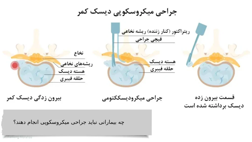 چه بیمارانی نباید جراحی میکروسکوپی انجام دهند؟
