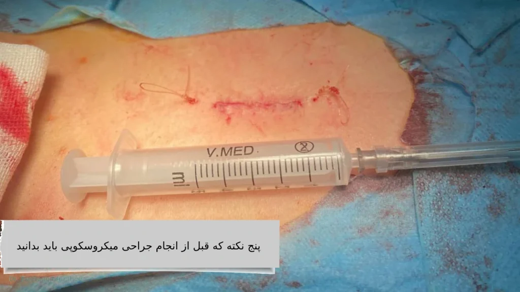 پنج نکته که قبل از انجام جراحی میکروسکوپی باید بدانید