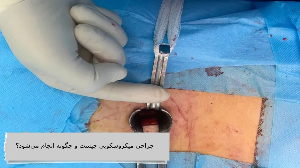 جراحی میکروسکوپی چیست و چگونه انجام می‌شود؟