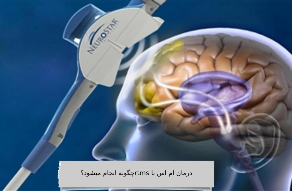 درمان ام اس با rtms چگونه انجام می شود؟ درمان ام اس با rtms چگونه انجام می شود؟
