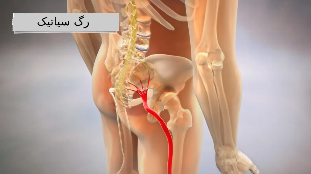 رگ سیاتیک: بزرگراه عصبی بدن شما!
