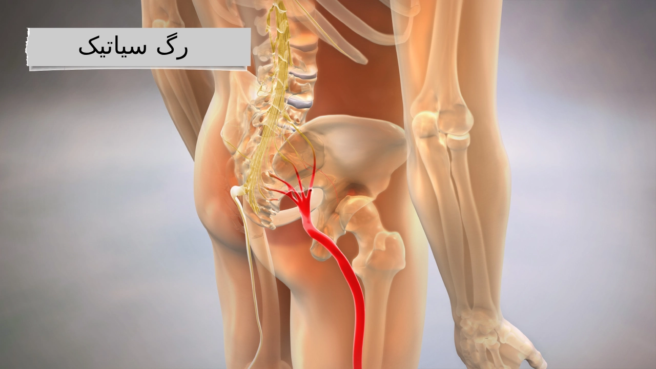رگ سیاتیک: بزرگراه عصبی بدن شما!