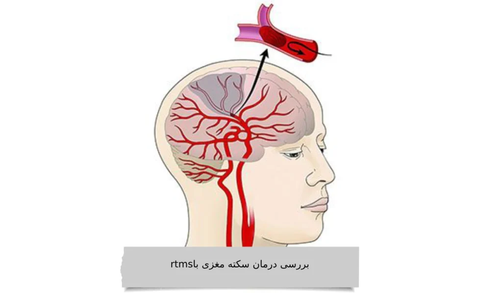 بررسی درمان سکته مغزی با rtms