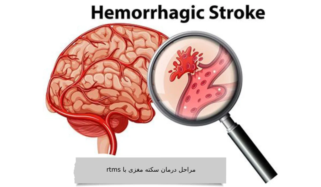 مراحل درمان سکته مغزی با rtms در ویستان مراحل درمان سکته مغزی با rtms