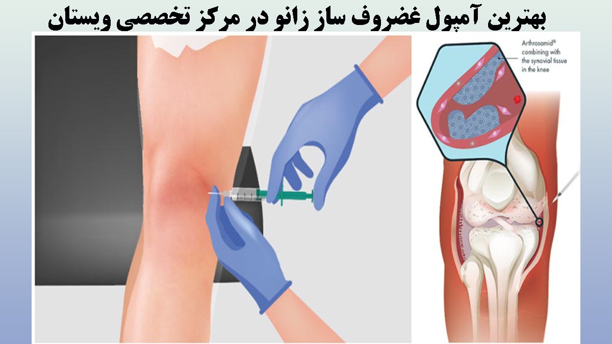 دو تصویر از زانوی آسیب دیده و تزریق آمپول به زانو