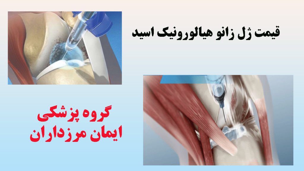ژل زانو هیالورونیک اسید دو تصویر از تزریق ژل به زانو