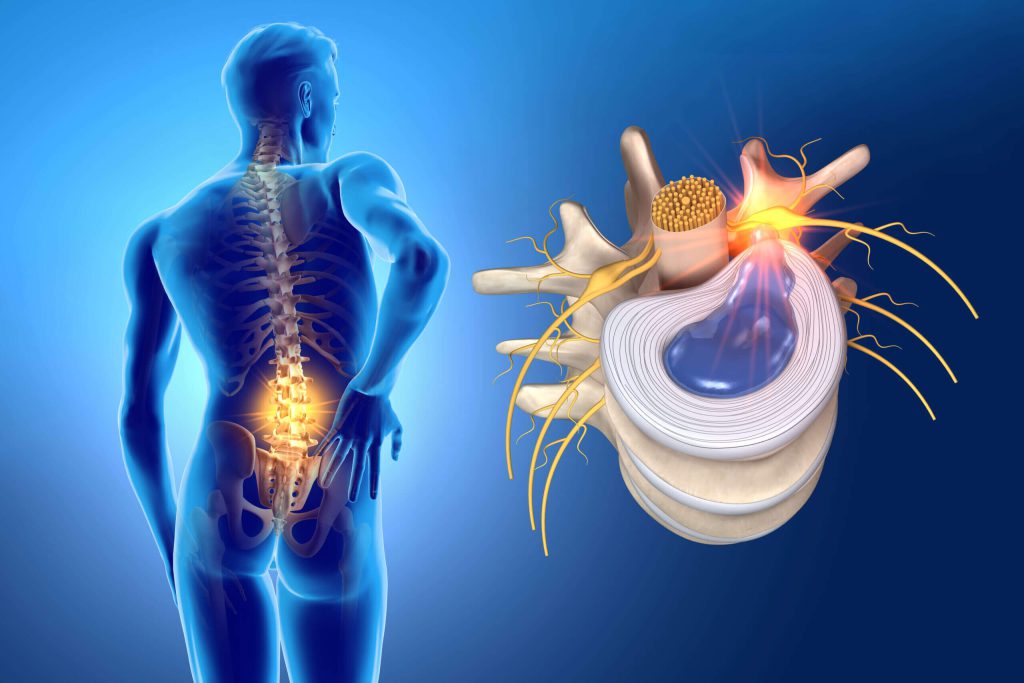 نحوه تشخیص دیسک کمر چگونه است