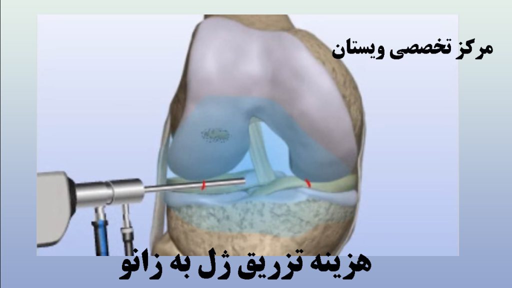 یک آمپول حاوی ژل غضروف ساز در حال تزریق به زانو
