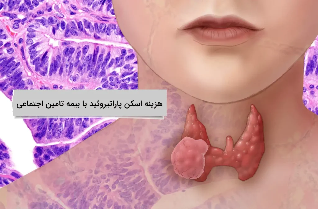 هزینه اسکن پاراتیروئید با بیمه تامین اجتماعی پوشش بیمه تامین اجتماعی چقدر است