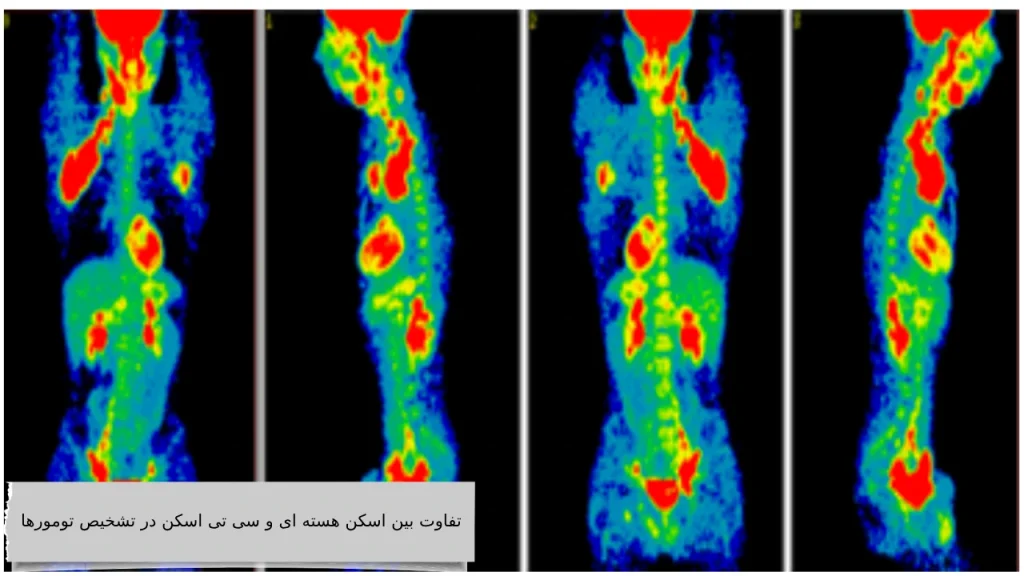  راجب تفاوت بین اسکن هسته ای و سی تی اسکن در تشخیص تومورها بیشتر بدانید
