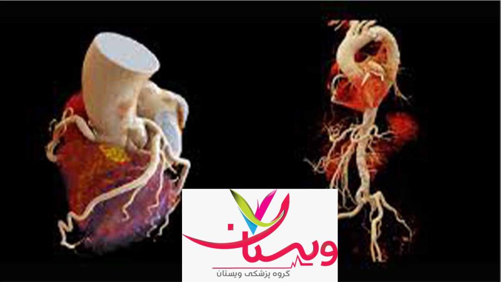 کاندیدای مناسب ام اس سی تی عروق کرونر قلب چیست؟