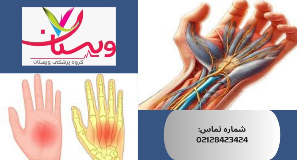 سندروم تونل کارپال | علائم، درمان قطعی و معرفی بهترین کلینیک 1404