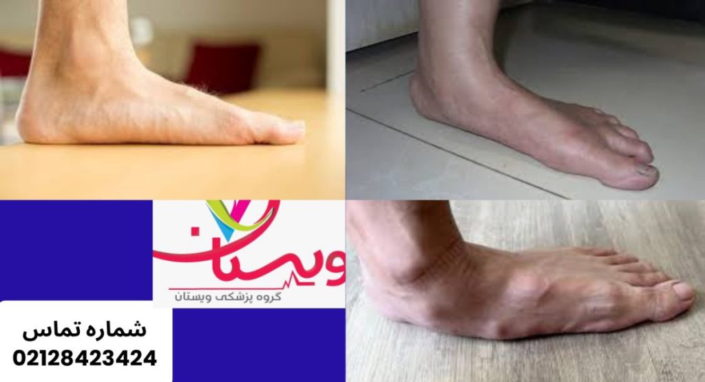 روشهای موثر برای درمان کف پای صاف روشهای موثر برای درمان کف پای صاف