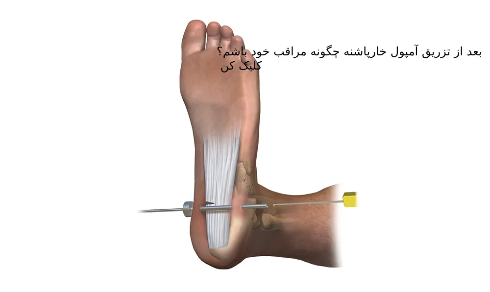 بعد از تزریق آمپول خارپاشنه چگونه مراقب خود باشم؟ کلیک کن!!