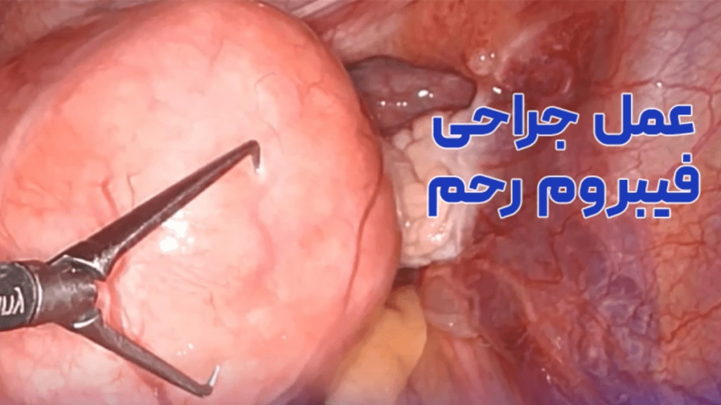 uterine-fibroid-surgery تصویری از عمل جراحی فیبروم رحم