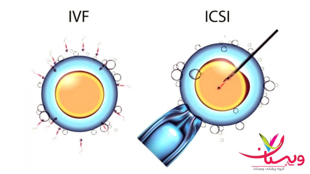 تصویری از تفاوت لقاح در ای وی اف و میکرواینجگشن یا ICSI