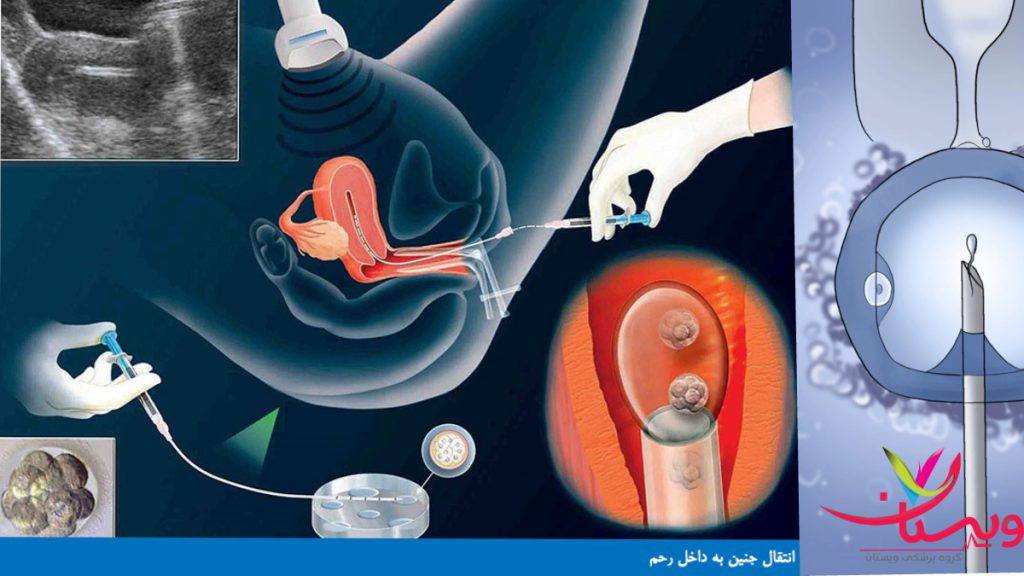 تصویری از مراحل انتقال جنین به رحم 