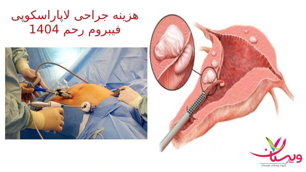 لاپاراسکوپی فیبروم رحم هزینه جراحی لاپاراسکوپی فیبروم رحم در سال 1404 - تصویری از جراحی و نمای رحم