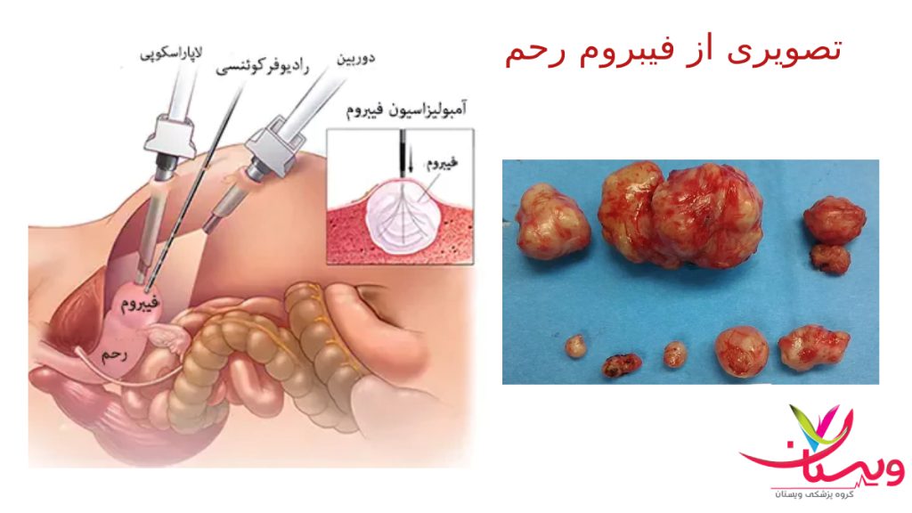 Multiple-fibroids عکس فیبروم رحم دفع شده