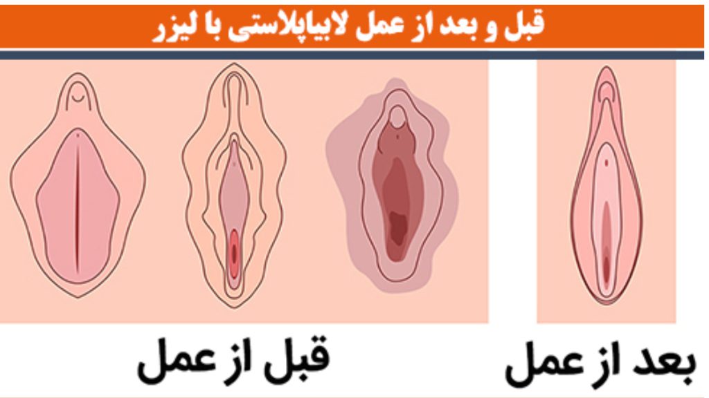 تصویر انیمیشنی از قبل و بعد لابیاپلاستی واژن