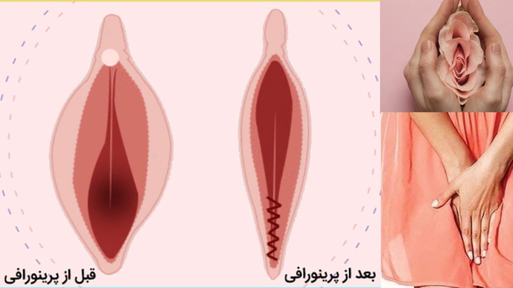 عکس قبل و بعد پرینوگرافی واقعی