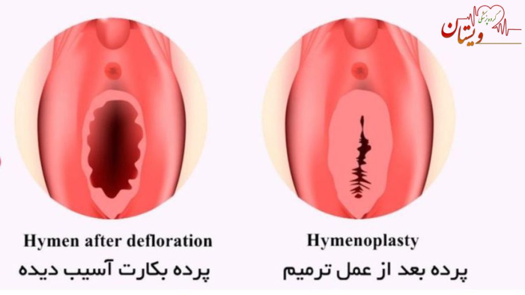 عکس انیمیشنی از مقایسه بکارت ترمیم شده
