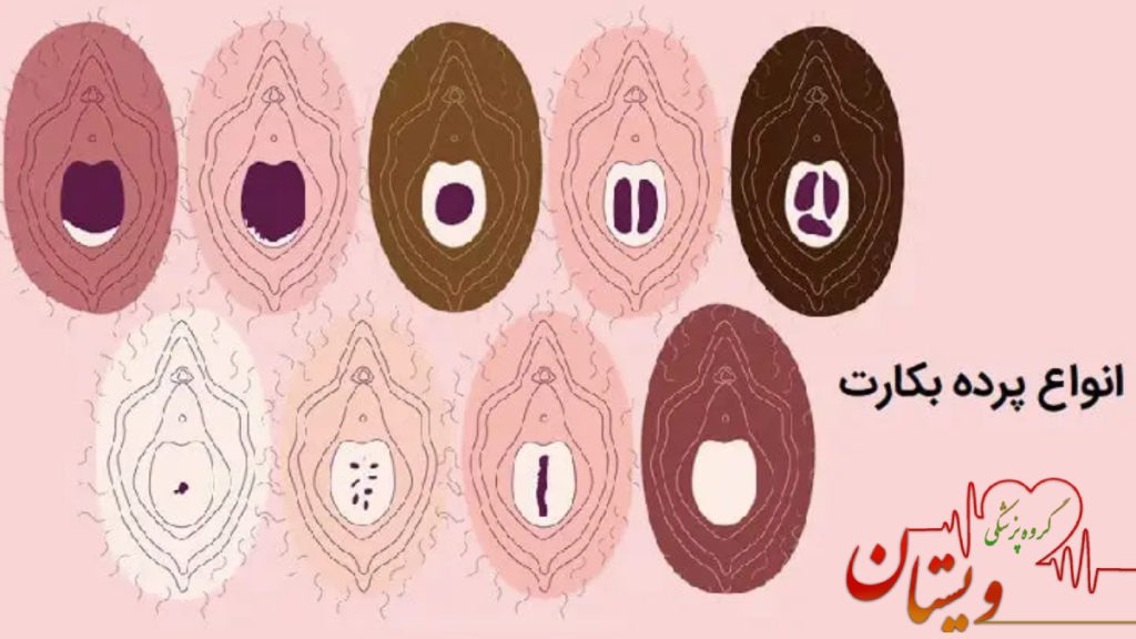 تصویر انیمیشنی از انواع پرده بکارت 
