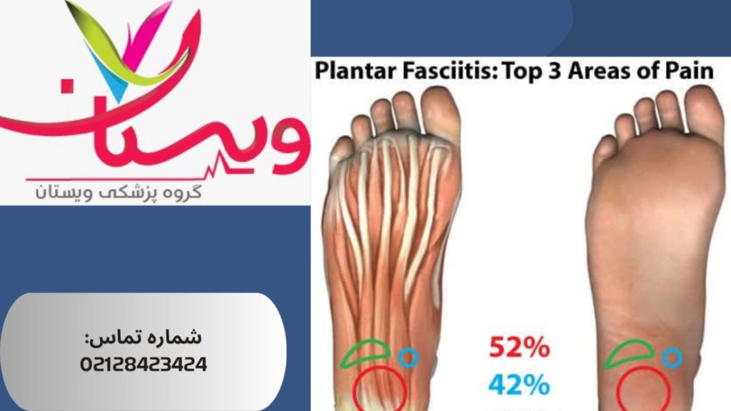 فاشئیت پلانتار (درد کف پا) 