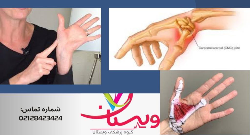 راههای درمان آرتروز انگشت شست راههای درمان آرتروز انگشت شست