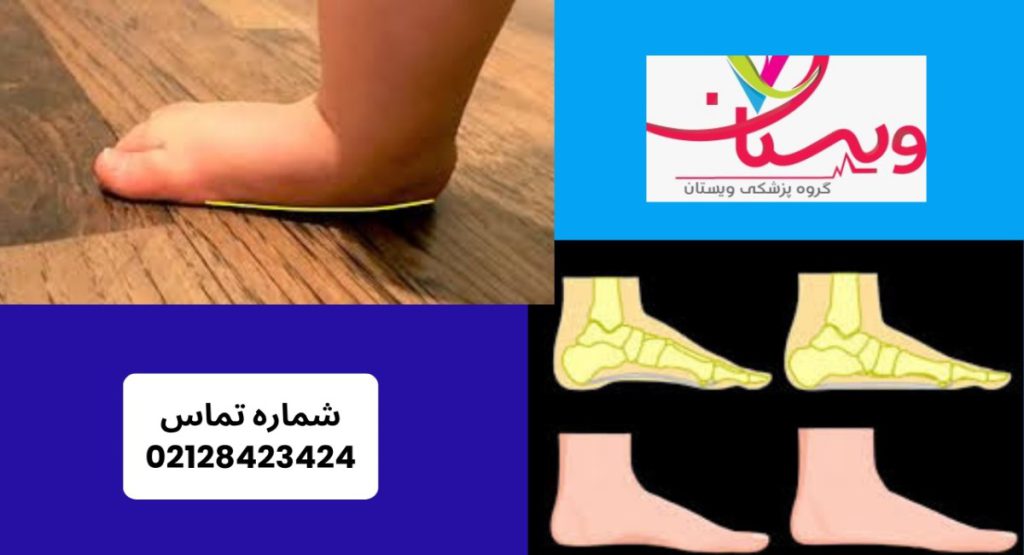 صافی کف پا (Flat foot) چیست؟ صافی کف پا (Flat foot) چیست؟