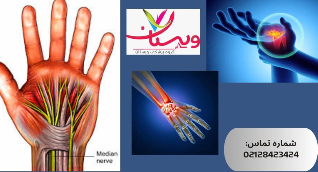 چرا سندروم تونل کارپال مهم است چرا سندروم تونل کارپال مهم است