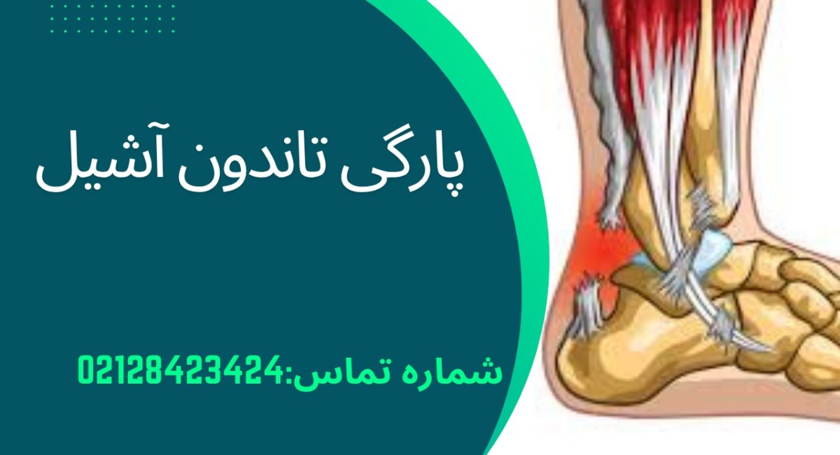 پارگی تاندون آشیل چیست؟ | علائم، درمان قطعی 1404