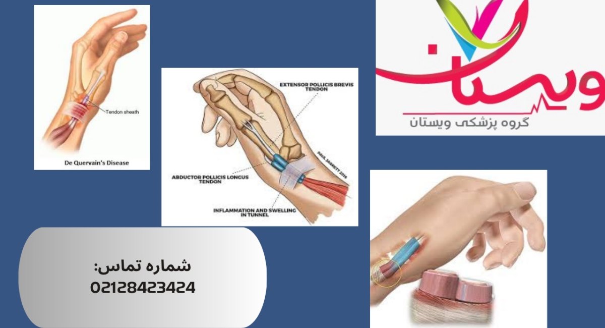 سندروم دکرون | علائم، تشخیص و بهترین درمان 1404