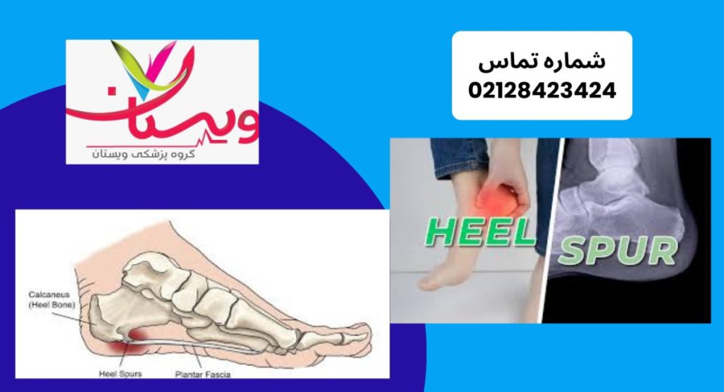 درمان خار پاشنه و اقدامات پیشنهادی درمان خار پاشنه و اقدامات پیشنهادی