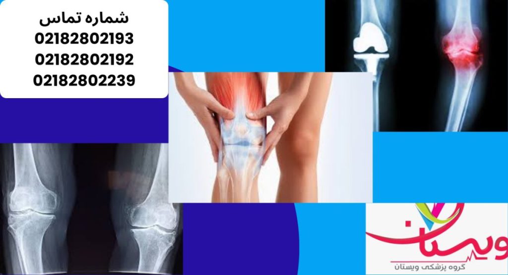 تمرینات خانگی مؤثر برای پیشگیری از آرتروز زانو